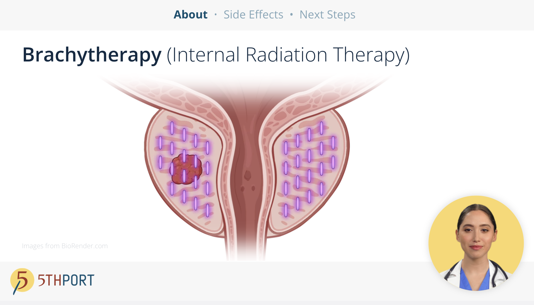 Brachytherapy Patient Education Workflow - Treatment Begins 3